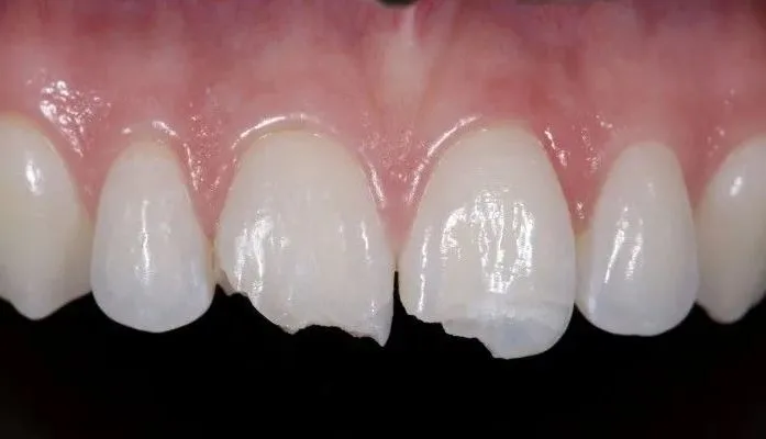 Broken Tooth